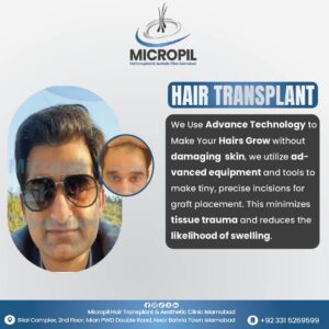 Hair transplant 2-01 (1)