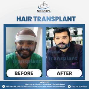 Hair transplant before after-01