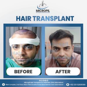 Hair transplant before after 2-01