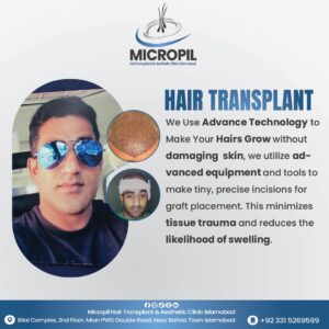 Hair transplant1-01