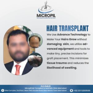 Hair transplant7-01